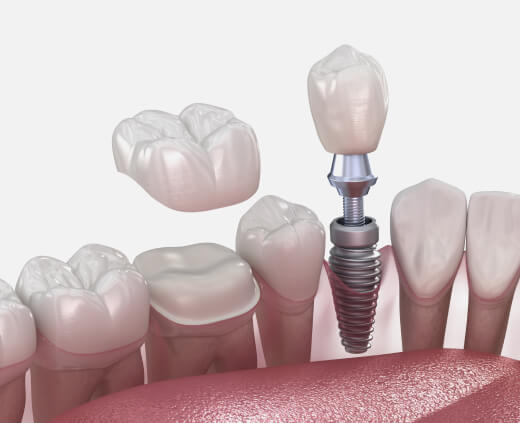 Dental Implants