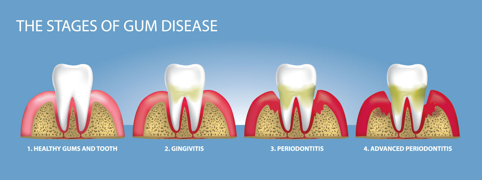 The Stages OF Gum Disease